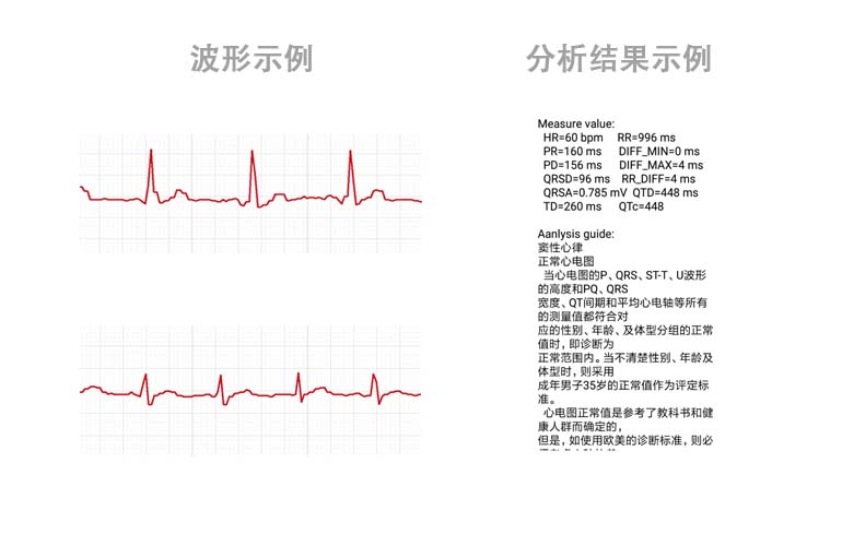 心電數(shù)據(jù)SDK算法庫(kù)----心電芯片、心電手環(huán)芯片、可穿戴心電設(shè)備、智能監(jiān)護(hù)儀